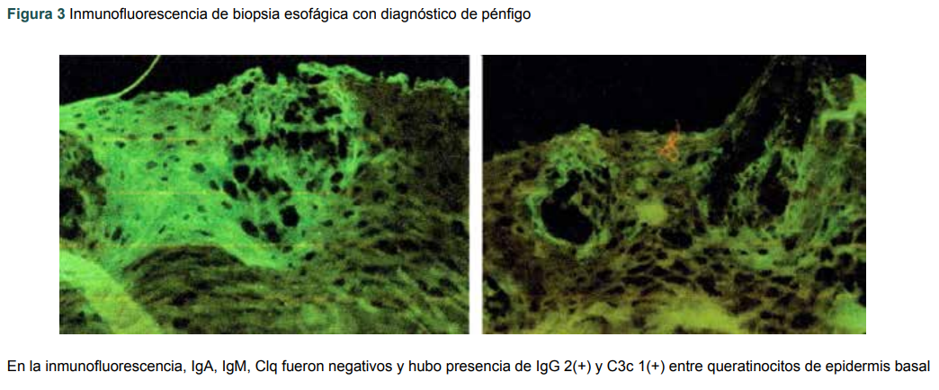 Inmunofluorescencia de biopsia esof�gica con diagn�stico de p�nfigo
