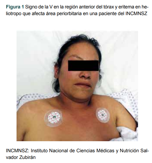 Signo de la V en la regi�n anterior del t�rax y eritema en heliotropo que afecta �rea periorbitaria en una paciente del INCMNSZ