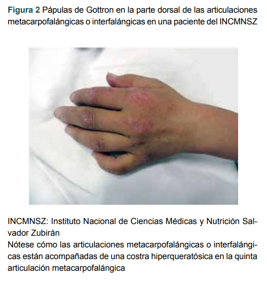 P�pulas de Gottron en la parte dorsal de las articulaciones metacarpofal�ngicas o interfal�ngicas en una paciente del INCMNSZ