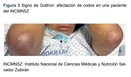 Signo de Gottron: afectaci�n de codos en una paciente del INCMNSZ