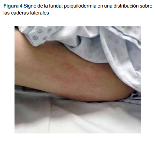 Signo de la funda: poiquilodermia en una distribuci�n sobre las caderas laterales