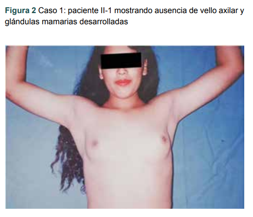 Caso 1: paciente II-1 mostrando ausencia de vello axilar y glándulas mamarias desarrolladas
