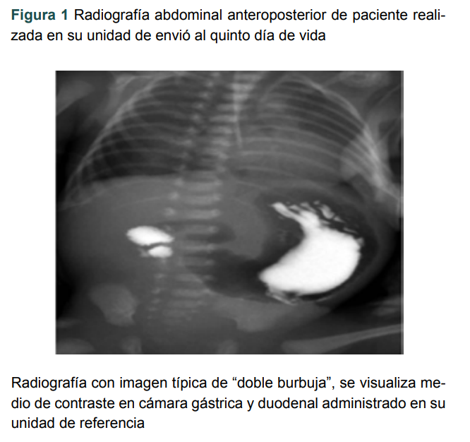 Radiograf�a abdominal anteroposterior de paciente realizada en su unidad de envi� al quinto d�a de vida