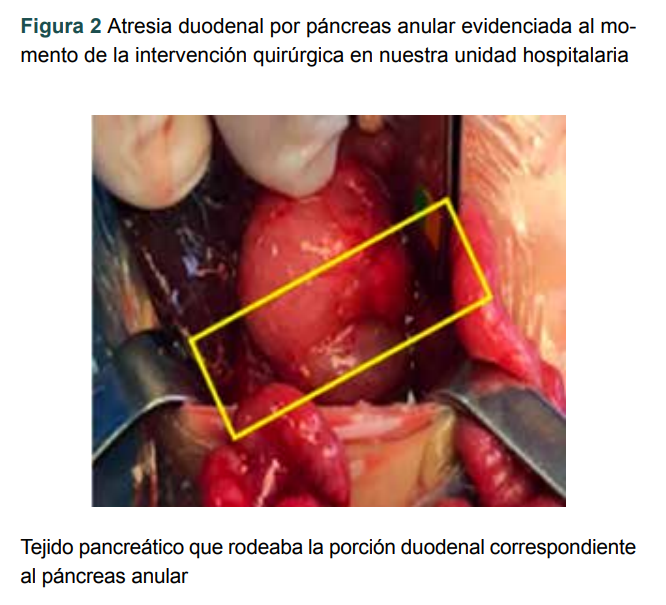 Atresia duodenal por p�ncreas anular evidenciada al momento de la intervenci�n quir�rgica en nuestra unidad hospitalaria