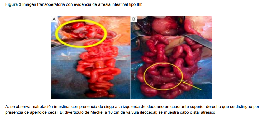 Imagen transoperatoria con evidencia de atresia intestinal tipo IIIb