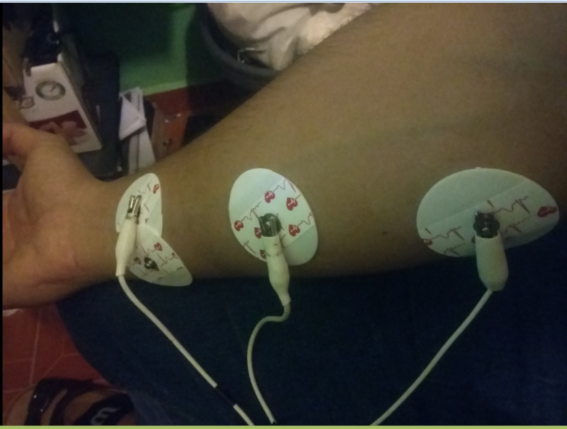 Colocación de los electrodos superficiales para realización de EMG.