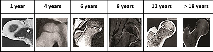 Morphologies displayed by human proximal femur at different ages
								Jones (n. d). Compilation
							generated based on images reported by Brouwers et al. 2006, Benson
								et al. 2010, Valteau et al.
								2011, Nakamura et al.
								2013, Vazquez-Noguerol et al.
								2013 and Vermaelen et al.
								2015.