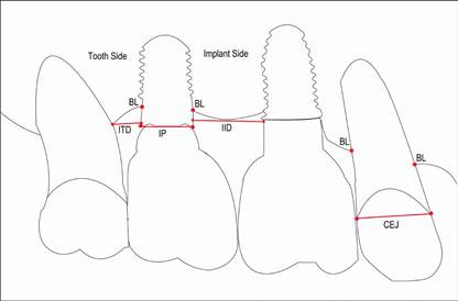 puntos de referencia fueron empleados para las mediciones radiogr&aacute;ficas: (IP) plataforma implante, (CEJ) l&iacute;nea cemento-am&eacute;lica, (BL) nivel &oacute;seo, (IID) distancia inter-implantes, (ITD) distancia implante-diente. Se muestra el lado de medici&oacute;n hacia implante y diente adyacentes.