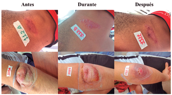 Lesiones en pacientes que presentaron las cargas parasitarias en frotis (BAS112) y en PBMC (BAS128) m&aacute;s altas al finalizar el seguimiento al tratamiento. BAS112: soldado profesional, de 24 a&ntilde;os de edad, con lesi&oacute;n en placa ubicada en el cuello y de posible lugar de infecci&oacute;n en San Jos&eacute; del Guaviare. El aspecto de la lesi&oacute;n cambi&oacute; durante el tratamiento a placa verrugosa. BAS128: sargento segundo, de 36 a&ntilde;os de edad, con una lesi&oacute;n ulcerada en el codo con presencia de reacci&oacute;n inflamatoria, que cedi&oacute; durante el tratamiento. Refiere haberse infectado en El Retorno, Guaviare, sin cambio en el &aacute;rea de la lesi&oacute;n al finalizar tratamiento (42 mm2 aproximadamente).