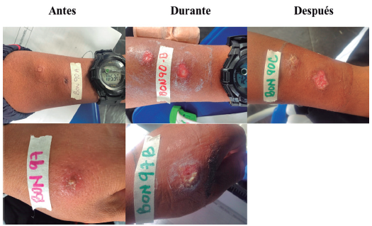 Lesiones en pacientes que presentaron cargas parasitarias elevadas o a considerar tanto en frotis como en PBMC. BON 90: soldado regular de 20 a&ntilde;os de edad, quien refiere infectarse en Campoalegre, Guain&iacute;a, con una &uacute;lcera en el brazo izquierdo. BON 97: soldado profesional de 30 a&ntilde;os, con &uacute;lcera en el antebrazo izquierdo, de posible lugar de infecci&oacute;n en San Jos&eacute; del Guaviare, Guaviare. En el seguimiento del tratamiento se evidencia que las lesiones se activaron durante el tratamiento.