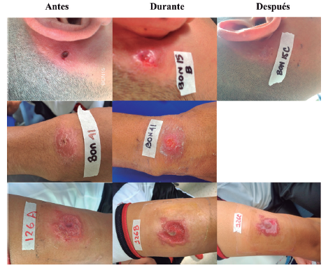 Lesiones en pacientes que no resolvieron seg&uacute;n criterio m&eacute;dico al finalizar el tratamiento. BON 15: subteniente, de 25 a&ntilde;os de edad, con lesi&oacute;n ulcerada, ubicada en la regi&oacute;n mastoidea, con posible lugar de infecci&oacute;n La Macarena, Meta. BON 41: soldado profesional de 19 a&ntilde;os, con una &uacute;lcera en la mano derecha; el paciente refiere haberse infectado en Puerto Caicedo, Putumayo. BON 126: cabo primero de 30 a&ntilde;os, con una &uacute;lcera en al antebrazo izquierdo, de posible lugar de infecci&oacute;n en San Jos&eacute; del Guaviare, Guaviare. Ninguna de las lesiones de estos tres pacientes disminuy&oacute; de tama&ntilde;o como para ser considerada la curaci&oacute;n m&eacute;dica.