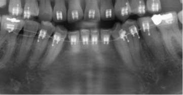 Toma parcial de una radiografía panorámica en la que se observa dientes con reabsorciones