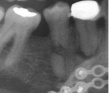 Toma parcial de una radiografía panorámica con hallazgo de fractura horizontal.