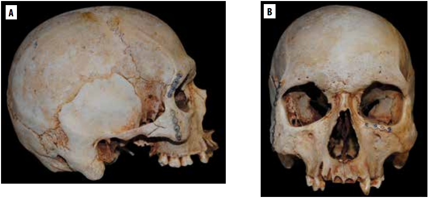 Cráneo en norma lateral derecha (A) y frontal (B), con características antropológicas masculinas y placas, fijadas con tornillos, en la región periorbitaria, bilateralmente.