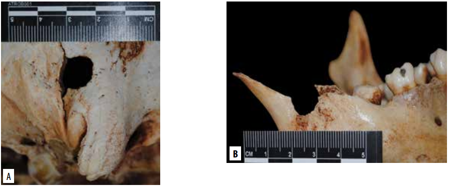 Orificios de entrada de proyectil de arma de fuego, en sector derecho de la región occipital (A) y rama mandibular derecha (B), fracturada.