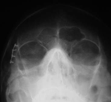 Radiografía PA de cráneo AM posquirúrgica, inmediata a la colocación de la primera placa de osteosíntesis.
