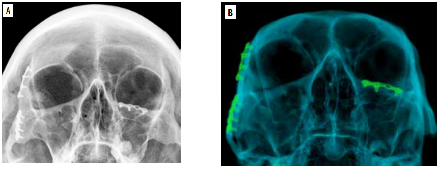 Radiografía PA (A) y reconstrucción tomográfica 3D (B) de cráneo PM.