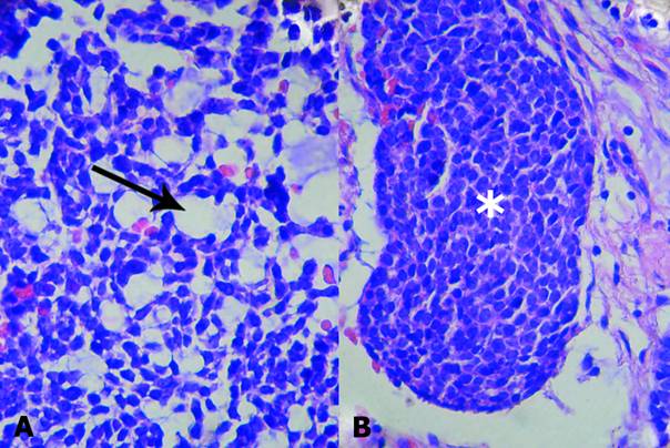 Patrones histológicos del adenocarcinoma de células basales