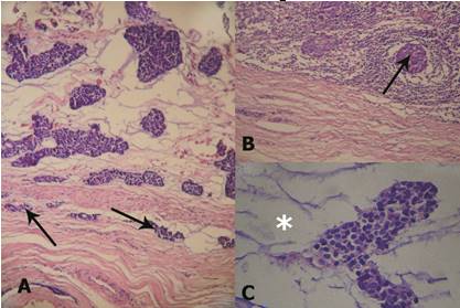 Adenocarcinoma de células basales con crecimiento infiltrante y metástasis