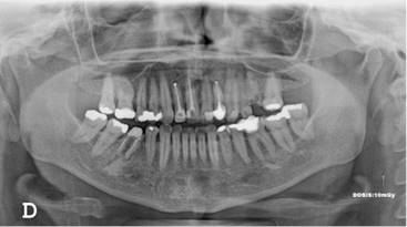 Radiografía panorámica en la que se observan dientes con tratamiento endodóntico