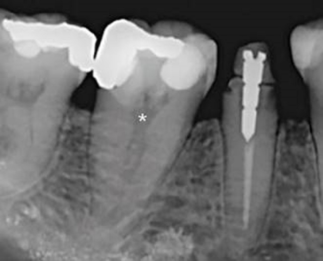 Radiografía periapical. Nótese la imagen difusa de un canal centrado en una única raíz en el primer molar mandibular (*), hallazgo sumamente infrecuente