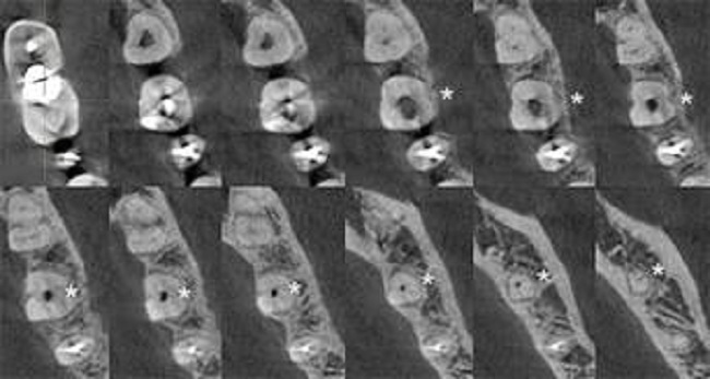 CBCT, múltiples imágenes en corte axial. Nótese la continuidad de un único canal sin presencia de canales accesorios (*)