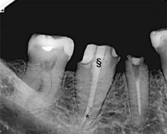 Radiografía periapical, 30 días posteriores al tratamiento endodóntico (*). Se observa buena recuperación tisular, ausencia de signos inflamatorios e inicio de la rehabilitación protésica programada con poste y tallado (§) para prótesis fija singular