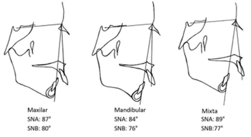 Esquemas simplificados de las mediciones de SNA y SNB en individuos de naturaleza esqueletal maxilar, mandibular y mixta.