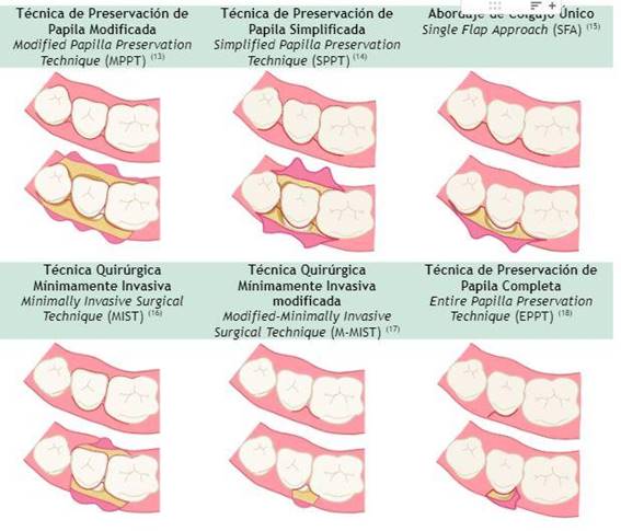 Esquemas de colgajos mínimamente invasivos para tratar defectos intraóseos, donde se observan distintas incisiones y características del diseño de los colgajos