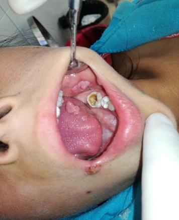 Lesiones tipo verrucosas en mucosa de carrillo