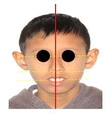 Fotografía extraoral del paciente de frente donde se observa alteraciones a nivel de línea media y asimetría facial