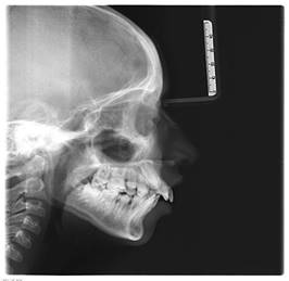 Radiografía lateral de cráneo donde se observa proinclinación de incisivos superiores y disminución de la longitud mandibular