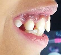 Fotografía lateral posterior a 6 meses de tratamiento donde se observa corrección del retrognatismo mandibular