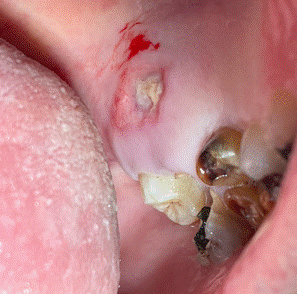 Se observa úlcera de fondo sucio, crateriforme, de bordes definidos de 10x10 mm de diámetro mayor, ubicada en mucosa palatina en relación a molares maxilares izquierdos. Dientes 2.6 y 2.7 en estado radicular.