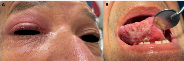  Lesiones en OD y vientre de lengua.