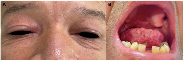 Manejo de lesiones en OD y vientre de lengua a los 2 meses.