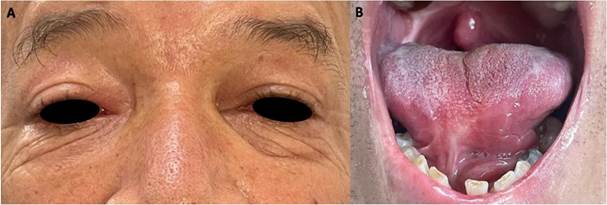 Manejo de lesiones en OD y vientre de lengua a los 9 meses.