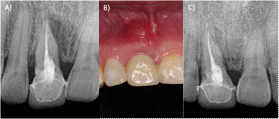 A) Radiografía preoperatoria orto-radial. B) Fotografía clínica preoperatoria, se observa aumento de volumen y cambio de coloración. C) Radiografía preoperatoria mesio-radial.