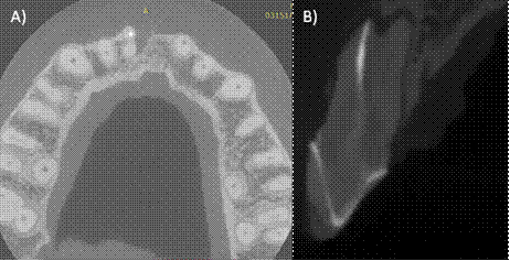 A) Corte axial de la tomografía, podemos observar dos raíces pertenecientes al órgano dental #11, la raíz vestibular presentar material de obturación, pero la raíz palatina no fue tratada, B) Corte sagital donde se comprueba un conducto palatino permeable.