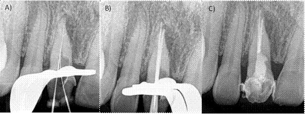 A) Radiografía intraoperatoria donde se observa el conducto completamente desobturado y la determinación de la longitud de trabajo. B) Prueba de punta principal C) Radiografía postoperatoria inmediata.