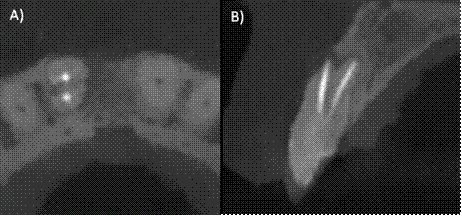 A) Corte axial de la tomografía, podemos observar dos zonas hiperdensas en las raíces compatibles con material de obturación en órgano dental #11. B) Corte axial de la tomografía, donde se aprecian ambos conductos radiculares obturados de manera adecuada.