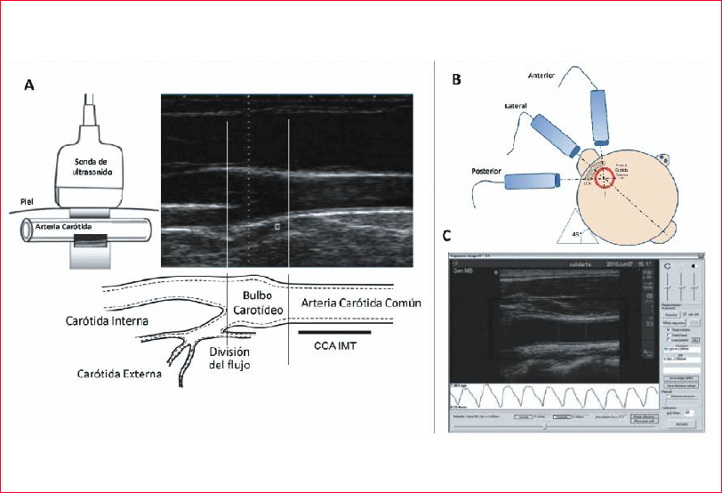 A: Esquema del sitio de medición carotídeo con sus sectores anatómicos marcados y la zona de determinación del espesor íntima media (IMT) en la porción distal de la arteria carótida común (CCA). Nótese el claro patrón de doble línea en la pared posterior. B: Esquema de los tres ángulos básicos de insonación con ultrasonido empleados para visualización de presencia de placas de ateroma y medición del IMT carotídeo (CMT). C: Pantalla del software utilizado para la determinación del CIMT y del diámetro arterial. A partir del análisis de un video, se obtiene la señal de diámetro arterial instantánea. El CIMT es calculado en el valor diastólico mínimo de los latidos (asterisco sobre la curva de diámetro). El re- cuadro dentro del cual se calculará el CIMT y el diámetro puede modificar sus dimensiones y posicionarse donde se desee. A y B son figuras construidas a partir de imágenes de Internet. C es construida a partir de imagen de software empleado en CUiiDARTE.