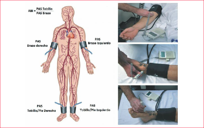 Forma de determinación del índice tobillo-brazo (ABI). PAS: Presión arterial sistólica. En las fotos se ilustran las formas de determinación de la PAS en la arteria braquial (arriba), tibial (medio) y dorsal del pie (abajo) mediante el método Doppler.