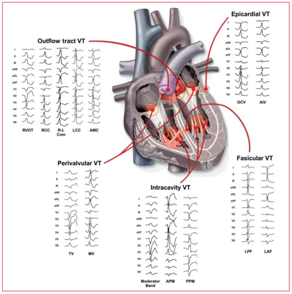 Morfolog&iacute;a de un electrocardiograma con 12 derivaciones de diferentes sitios de origen en la taquicardia ventricular idiop&aacute;tica. RVOT, tracto de salida del ventr&iacute;culo derecho; RCC, c&uacute;spide de la coronaria derecha; R&ndash;L COM comisura de la c&uacute;spide de la coronaria derecha-izquierda; CC, c&uacute;spide de la coronaria izquierda; AMC, continuidad aortomitral; TV, anillo tricusp&iacute;deo; MV, anillo mitral; APM, PAP anterior; PPM, PAP posterior; LPF, fasc&iacute;culo posterior izquierdo; LAF, fasc&iacute;culo anterior izquierdo; GCV, vena card&iacute;aca magna; AIV, vena interventricular anterior. Reproducido de Tanawuttiwat y colaboradores, reimpreso gracias a la generosidad de Tanawuttiwat y colaboradores(25)