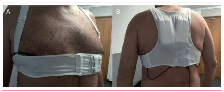 Desfibrilador cardioversor port&aacute;til. Modelo de desfibrilador cardioversor port&aacute;til. Im&aacute;genes cortes&iacute;a de IS, reimpreso con el generoso permiso y consentimiento del paciente.