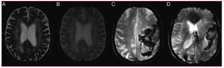 Pacientes con fibrilaci&oacute;n auricular considerados como no adecuados para anticoagulaci&oacute;n oral T2 (A) y T2* (B) imagen a 1,5 T que demuestra la confluencia de hiperintensidades de sustancia blanca y microsangrados cerebrales en un paciente con fibrilaci&oacute;n auricular con im&aacute;genes (C/D) de accidente isqu&eacute;mico transitorio reciente en 3,0 T, demostrando una hemorragia lobar aguda y m&uacute;ltiples microsangrados cerebrales en un paciente con fibrilaci&oacute;n auricular con sospecha de angiopat&iacute;a amiloide cerebral(59).