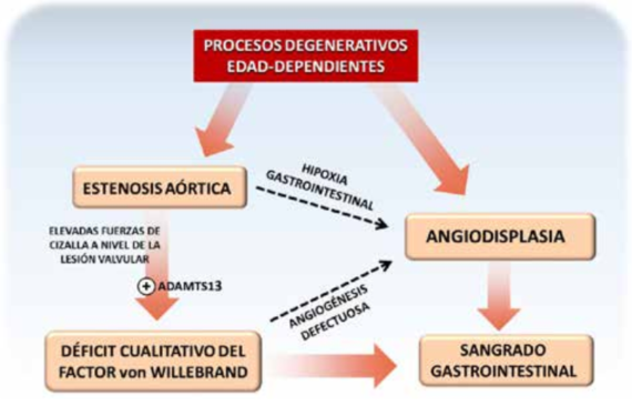 Figura 7: Concepto fisiopatolgico unificador del sndrome de Heyde. Tanto la estenosis artica como las angiodisplasias aumentan su prevalencia con la edad, por procesos interpretados como “degenerativos”. Existe incontrovertible evidencia de que la valvulopata origina con frecuencia una ditesis hemorrgica por dficit selectivo de los multmeros de alto peso molecular del factor von Willebrand, originado en un exceso de actividad de su enzima proteoltica especfica, la ADAMTS13. Esta deficiencia, definida como una enfermedad de von Willebrand adquirida de tipo 2A, favorece el sangrado de angiodisplasias coexistentes. Adicionalmente, se han dilucidado mecanismos moleculares por los cuales la estenosis artica puede inducir no solo el sangrado, sino el desarrollo de estas malformaciones vasculares (modificado de Sucker y col.(37)).