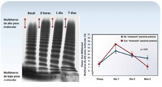 Figura 8: Efecto de la sustitucin valvular artica en la proporcin de los multmeros de alto peso molecular (PM) del factor von Willebrand (fvW). A la izquierda, electroforesis del fvW en gel de agarosa antes y despus de la sustitucin valvular. Se observa un dficit de los multmeros de alto PM en el preoperatorio y su recuperacin luego del procedimiento en varios puntos de corte temporal. Las flechas sealan el rea de migracin de los multmeros mayores. A la derecha, seguimiento hasta 6 meses del posoperatorio. Luego de su recuperacin inicial, las macromolculas vuelven a caer en forma significativa en los pacientes con mismatch protsico, confirmando la relacin causal entre el trastorno hemodinmico propio de la valvulopata y el defecto de la hemostasis (modificado de Vincentelli y col.(26)).