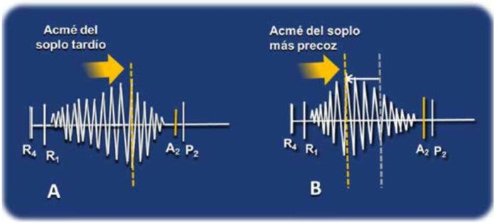 Figura 9: Modificaciones del soplo de estenosis artica inducidos por una anemia severa. A: Sin anemia. El soplo caracterstico de la estenosis artica severa tiene un acm tardo, mesotelesistlico. B: Con anemia. El flujo transartico instantneo y, por lo tanto, la intensidad del soplo son mximos en la protomesosstole. La auscultacin de un acm tardo del soplo en un paciente con estenosis artica y anemia sugiere severidad de la valvulopata, si bien la evaluacin clnica y ecocardiogrfica ms confiable tiene lugar luego de su reposicin.