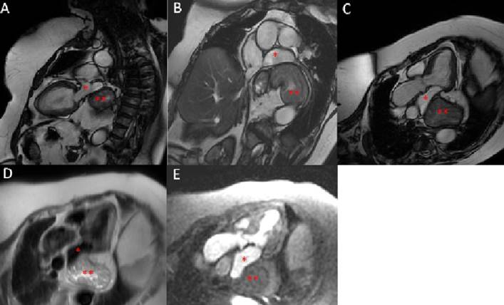 Figura 1: Resonancia magntica cardaca. A-B-C) Secuencias de cine donde se puede observar una masa extracardaca en el sector posterior de la aurcula izquierda (*) que corresponde a la cavidad gstrica (**), compatible con hernia hiatal. D) Secuencia ponderada en T2. E) Secuencia de perfusin.